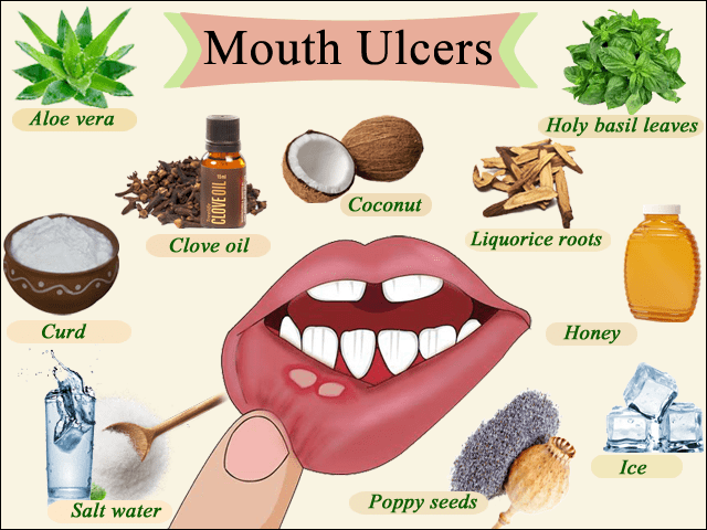 mouth ulcers in hindi
