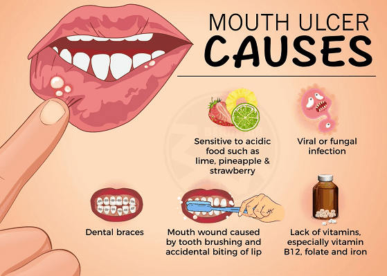 mouth ulcers in hindi